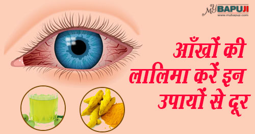आँखों की लालिमा करें इन उपायों से दूर | How to Get Rid of Red Eyes: Home Remedies