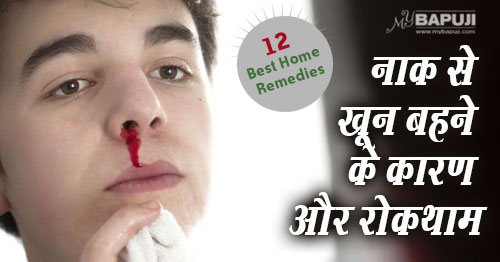 116-Natural-Home-Remedies-to-Prevent-Nosebleeds(Epistaxis)