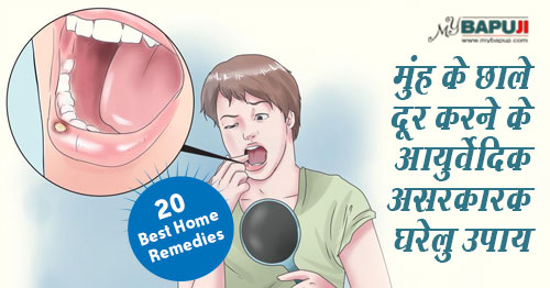 मुंह के छाले दूर करने के घरेलू उपाय  | Mouth Ulcers Home Remedies in Hindi