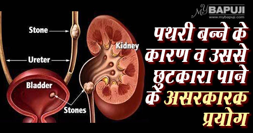 पथरी बन्ने के कारण व उससे छुटकारा पाने के असरकारक प्रयोग | Kidney Stones: Causes, Symptoms, and Treatments