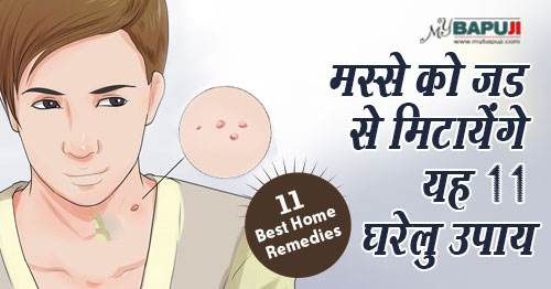 मस्से को जड से मिटायेंगे यह 11 घरेलू उपाय | Masse Hatane ka Tarika in Hindi