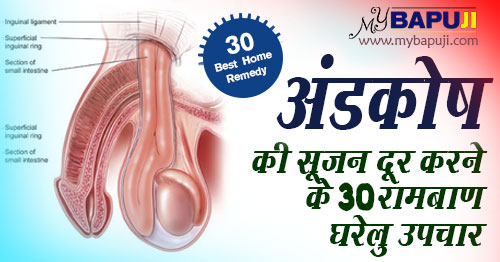 अंडकोष की सूजन दूर करने के 30 रामबाण घरेलू उपचार - Andkosh me Sujan ka Gharelu Ilaj in Hindi
