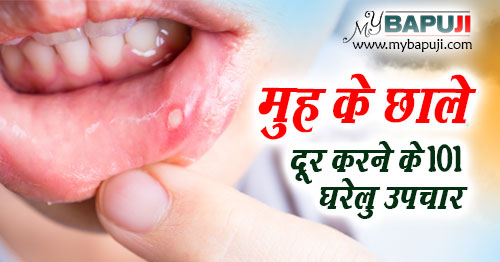 Mouth Ulcers muh ke chale ke Ayurvedic gharelu nuskhe in hindi