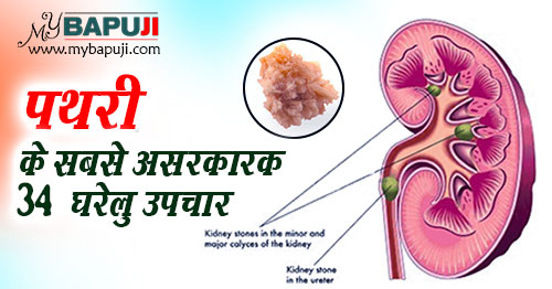 पथरी के 34 सबसे असरकारक घरेलू उपचार - Kidney Stone Treatment in Hindi