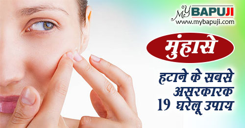 Acne Pimples Home remedies in Hindi