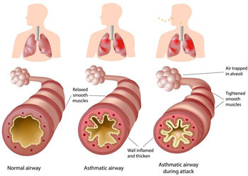 श्वासनली की सूजन दूर करने के 19 रामबाण उपाय | Bronchitis Home Remedies Bronchitis Home Remedies in hindi - श्वासनली की सूजन दूर करने के 19 रामबाण उपाय | Bronchitis Home Remedies