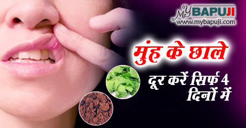 मुंह के छालों के 23 सबसे असरकारक देशी इलाज | Muh ke Chhalon ka ilaj