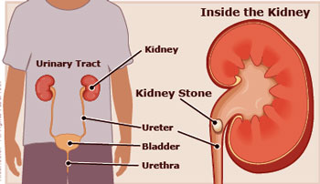 ureter stone home remedy in hindi