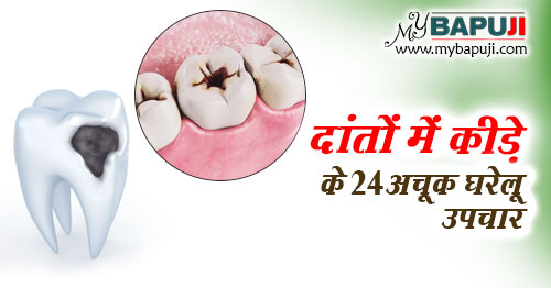 दांतों में कीड़े लगने के कारण, लक्षण और उपचार - Tooth Cavities: Symptoms, Causes, and Treatments
