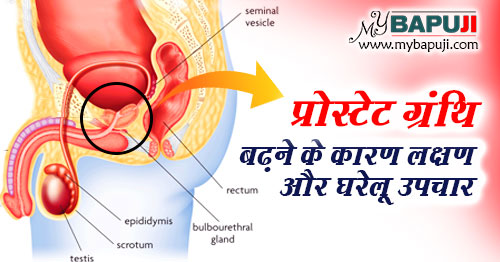 प्रोस्टेट ग्रंथि बढ़ने के घरेलू इलाज - Prostate Granthi Badhne ka Gharelu Ilaj in Hindi
