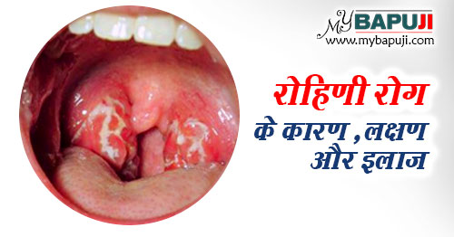 रोहिणी रोग के कारण ,लक्षण और इलाज | Diphtheria Treatment in Hindi