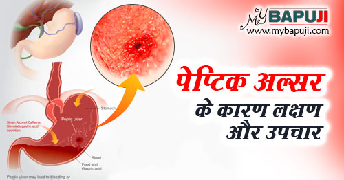 पेप्टिक अल्सर के कारण ,लक्षण ,दवा और घरेलू इलाज | Stomach (Peptic) Ulcers: Symptoms, Causes, and Treatment in hindi