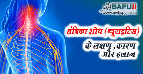 तंत्रिका शोथ (न्यूराइटिस) के लक्षण ,कारण और इलाज | Naso ke Dard ka ilaj in Hindi