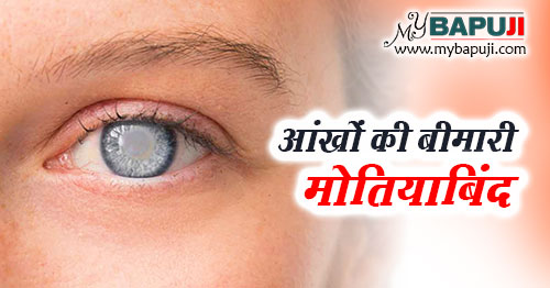 आंखों की बीमारी मोतियाबिंद : कारण ,लक्षण और इलाज