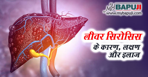 लीवर सिरोसिस के कारण, लक्षण, परहेज और इलाज | Liver Cirrhosis ke karan, lakshan aur ilaj in Hindi
