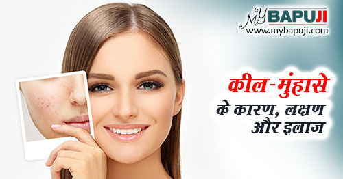 मुंहासे के कारण, लक्षण, इलाज, नुस्खे, दवा और घरेलू उपाय - Home Remedies for Pimples in Hindi