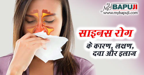 साइनस (साइनोसाइटिस) के कारण, लक्षण, दवा और इलाज - Sinusitis Ke Lakshan, Karan, Dawa aur Ilaj in Hindi