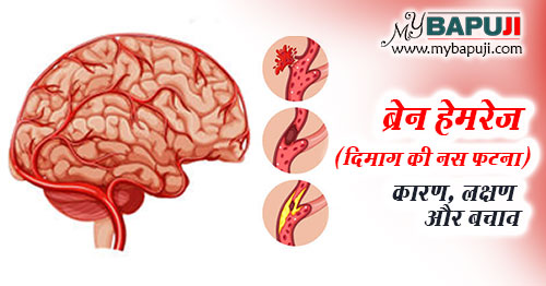 ब्रेन हेमरेज : कारण, लक्षण और बचाव - Brain Hemorrhage in Hindi