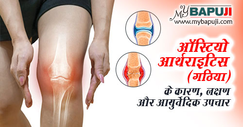 ऑस्टियो आर्थराइटिस (गठिया/ संधिवात) - Osteoarthritis Ayurvedic Treatment in Hindi