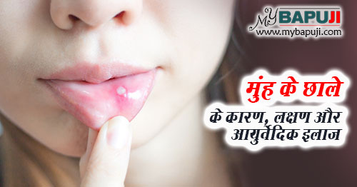 मुंह के छाले का आयुर्वेदिक इलाज - Muh ke Chale ka Ayurvedic Ilaj in Hindi