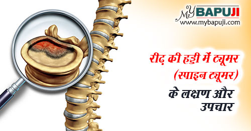 रीढ़ की हड्डी का ट्यूमर (स्पाइन ट्यूमर) - Spinal Tumor in Hindi