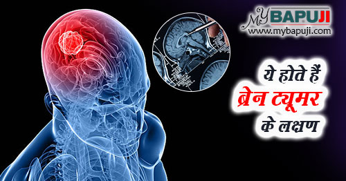 ब्रेन ट्यूमर क्या है ? इसके लक्षण, प्रकार और इलाज - Brain Tumor kya Hai, Lakshan aur Ilaj in Hindi