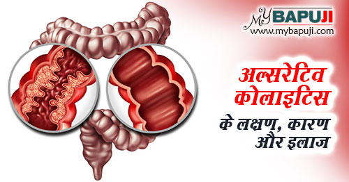 अल्सरेटिव कोलाइटिस - Ulcerative Colitis in Hindi