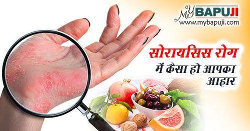 सोरायसिस रोग में कैसा हो आपका आहार - Your Diet During Psoriasis in Hindi