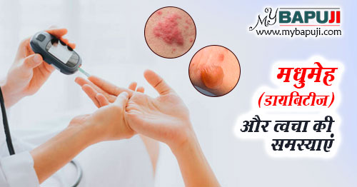 मधुमेह (डायबिटीज) और त्वचा की समस्याएं - Diabetes and Skin Problems in Hindi