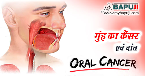 मुंह का कैंसर (ओरल कैंसर) एवं दांत - Oral Cancer And Teeth