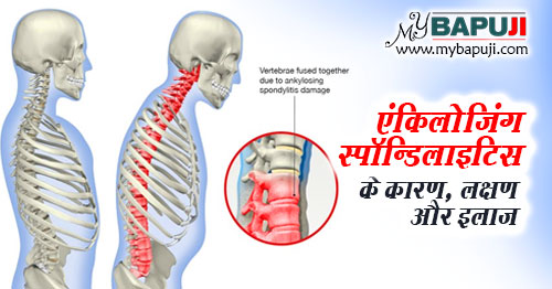 एंकिलोजिंग स्पॉन्डिलाइटिस (रीढ़ का गठिया) - All about Ankylosing Spondylitis in Hindi