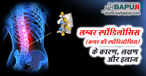 लम्बर स्पोंडिलोसिस (कमर की स्पोंडिलोसिस) – All about Lumbar spondylosis in Hindi