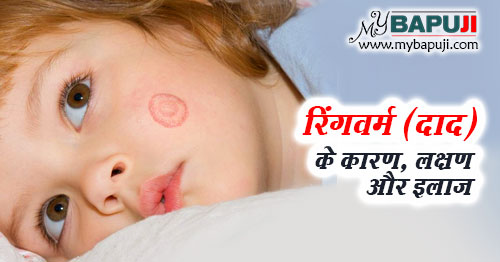 रिंगवर्म (दाद) - All about Ringworm in Hindi