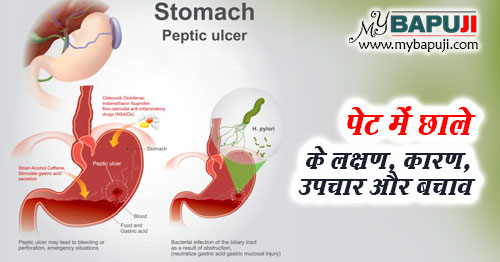 पेट के छाले – All about Peptic Ulcer in Hindi
