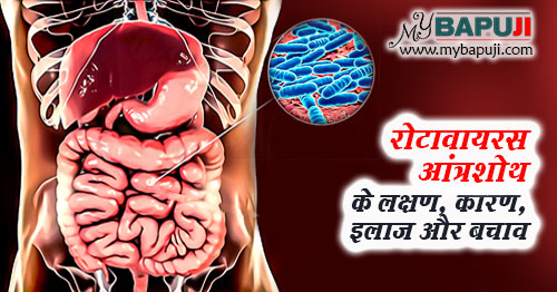 रोटावायरस आंत्रशोथ – All about Rotavirus Gastroenteritis in Hindi
