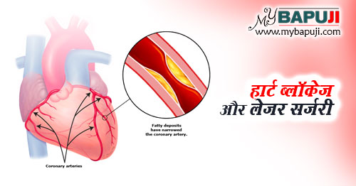 heart blockage aur laser surgery in hindi