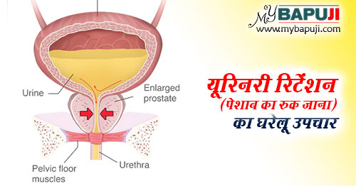 Urinary Retention ka gharelu Ayurvedic Ilaj in Hindi