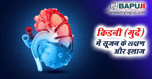 किडनी (गुर्दे) में सूजन के लक्षण और इलाज - Kidney me Sujan ke Lakshan aur Ilaj in Hindi