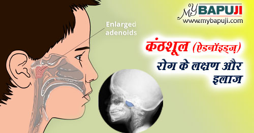 कंठशूल (ऐडनॉइड्ज़) रोग के लक्षण और इलाज - Adenoids ke Lakshan aur ilaj in Hindi