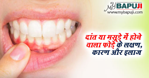 दांत या मसूड़े में होने वाला फोड़े के लक्षण, कारण और इलाज