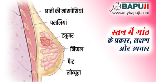 स्‍तन में गांठ के प्रकार, लक्षण और उपचार - Stan me Ganth ke Prakar, Lakshan aur ilaj