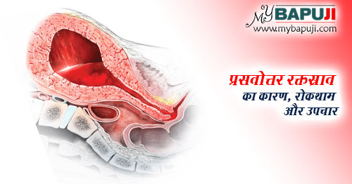 प्रसवोत्तर रक्तस्राव का कारण, रोकथाम और उपचार - Postpartum Hemorrhage ka Karan aur Upchar